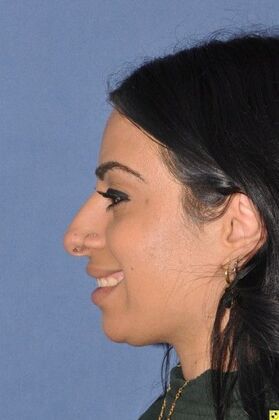 Rhinoplasty: Tip refinement and rotation - Before