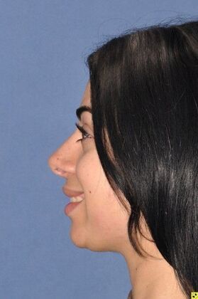Rhinoplasty: Tip refinement and rotation - After
