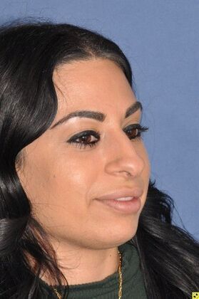 Rhinoplasty: Tip refinement and rotation - Before