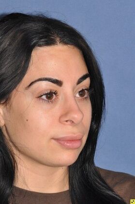 Rhinoplasty: Tip refinement and rotation - After