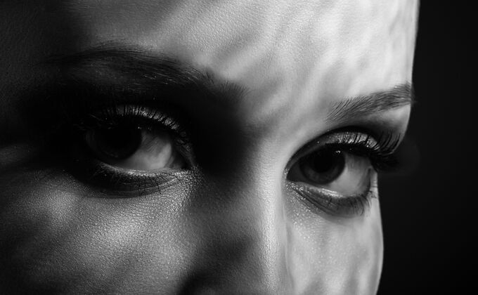 Eye Lift (Blepharoplasty) Cases