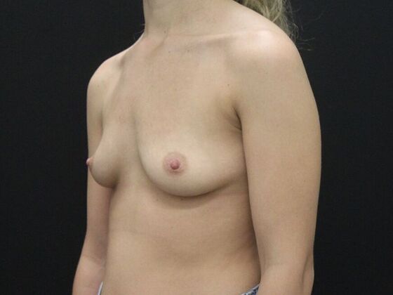 Breast Augmentation: Case 128 - Before