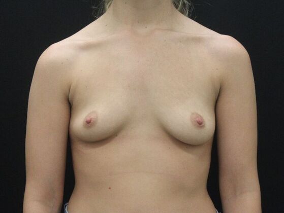 Breast Augmentation: Case 128 - Before