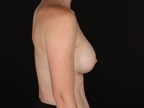 Breast Augmentation: Case 129 - After