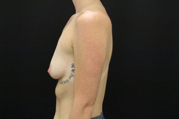 Breast Augmentation: Case 129 - Before