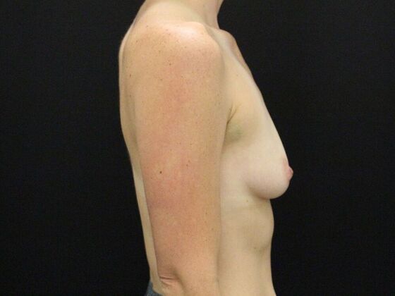 Breast Augmentation: Case 129 - Before