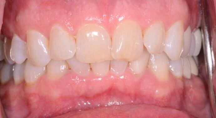 Clear Aligners Case 1 - Before