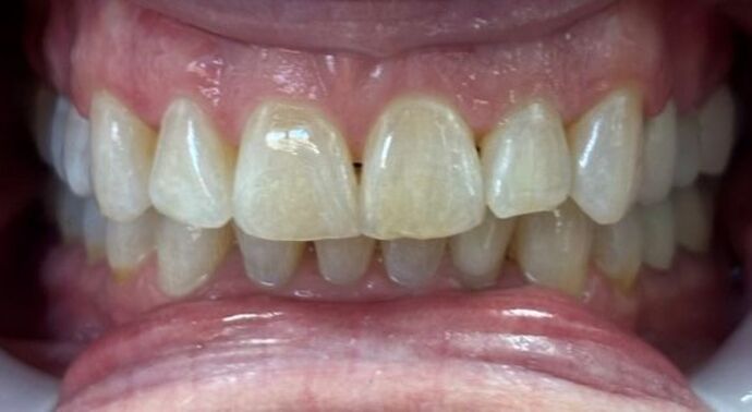 Clear Aligners Case 1 - After