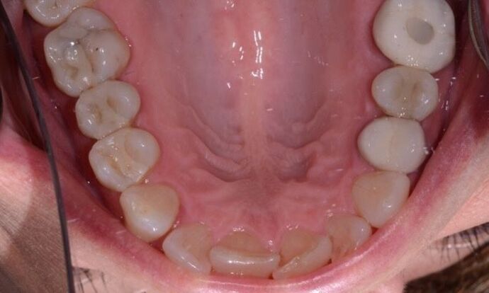 Clear Aligners: Case 1 - Before