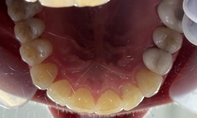 Clear Aligners: Case 1 - After