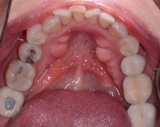 Clear Aligners: Case 1 - Before