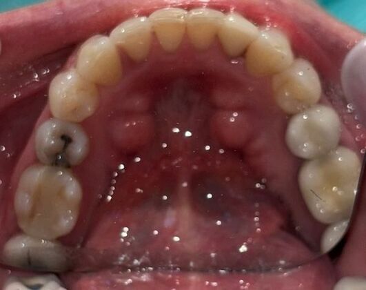 Clear Aligners: Case 1 - After