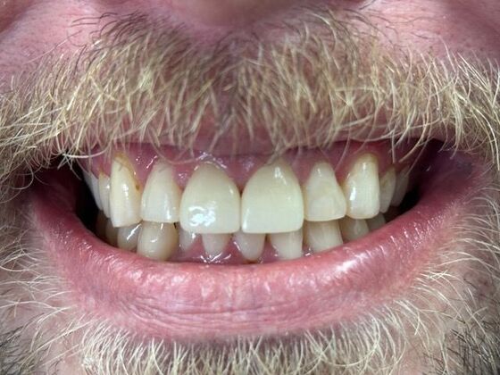 Dental Crowns: Case 2