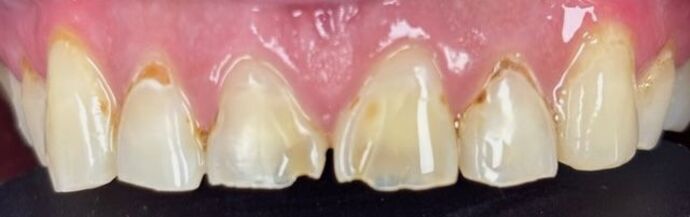 Dental Crowns: Case 2 - Before