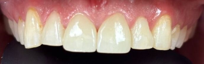 Dental Crowns: Case 2 - After
