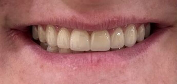 Veneers Case 1 - After