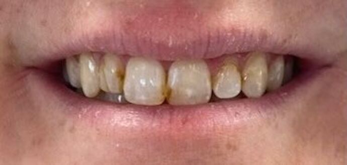 Veneers Case 1 - Before