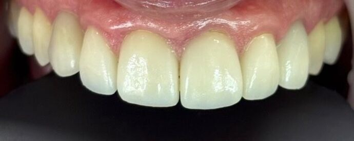 Veneers Case 2 - After