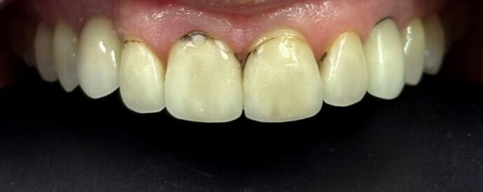 Veneers Case 2 - Before