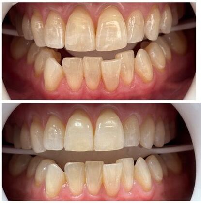 Teeth Whitening Case 2