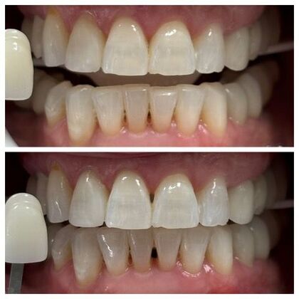 Teeth Whitening Case 3