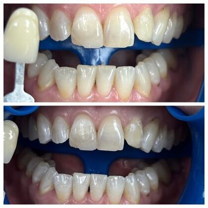 Teeth Whitening Case 4