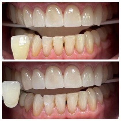 Teeth Whitening Case 5