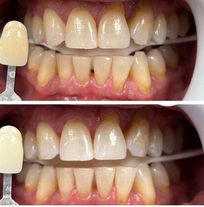 Teeth Whitening Case 6