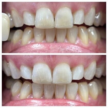 Teeth Whitening Case 7