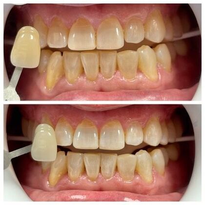 Teeth Whitening Case 8