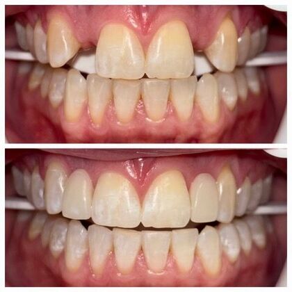 Teeth Whitening Case 9