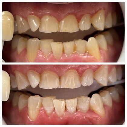 Teeth Whitening Case 10