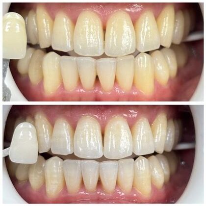 Teeth Whitening Case 11