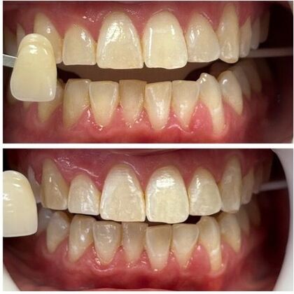 Teeth Whitening Case 12