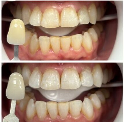 Teeth Whitening Case 13