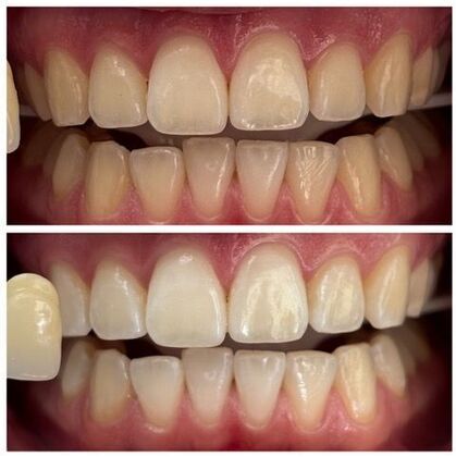 Teeth Whitening Case 14