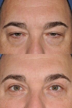 Eyelid Surgery Upper and lower lids in a man