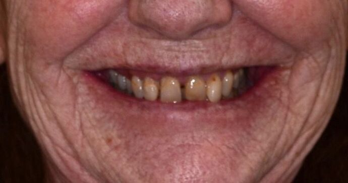 All-on-X: Case 1 - Before