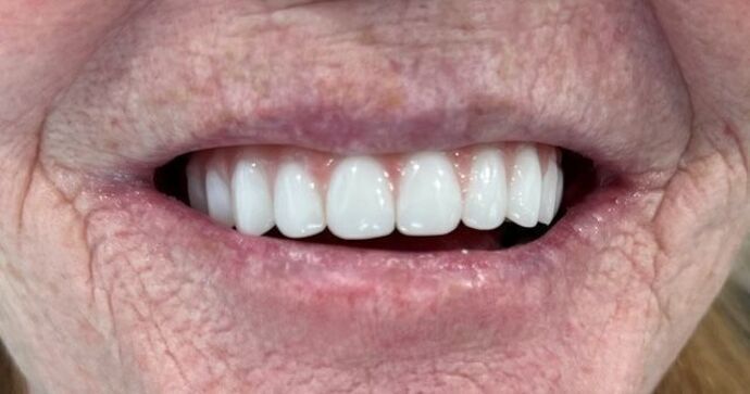 All-on-X: Case 1 - After