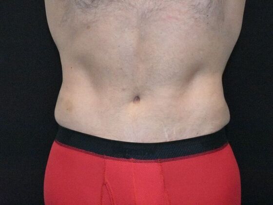 Abdominoplasty: Case 39 - After