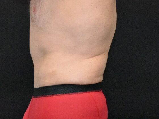 Abdominoplasty: Case 39 - After