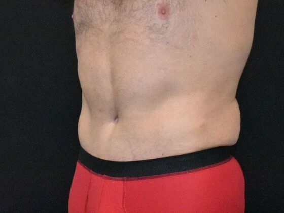 Abdominoplasty: Case 39 - After