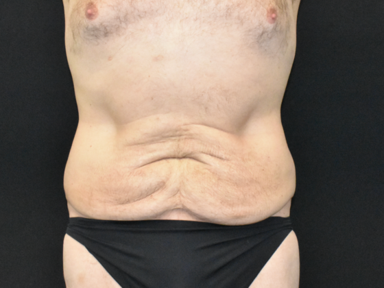 Abdominoplasty: Case 39 - Before