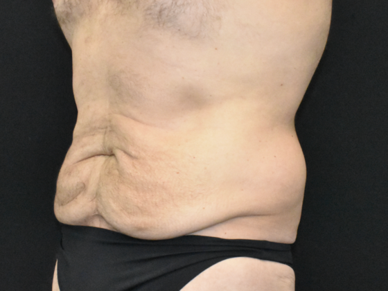 Abdominoplasty: Case 39 - Before