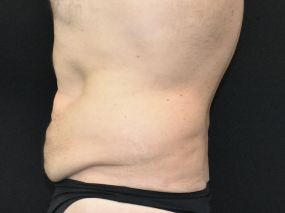Abdominoplasty: Case 39 - Before