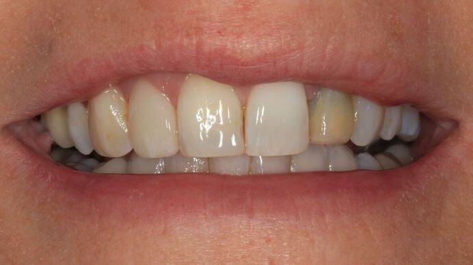 Full Mouth Reconstruction Case 52 - Before