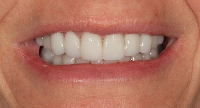 Full Mouth Reconstruction Case 52 - After