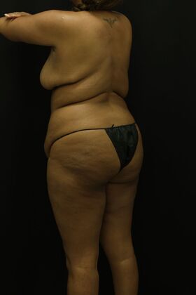 Tummy Tuck: Case 85 - Before