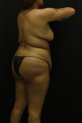 Tummy Tuck: Case 85 - Before