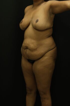 Tummy Tuck: Case 85 - Before